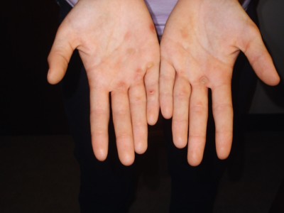 Blistery Hands